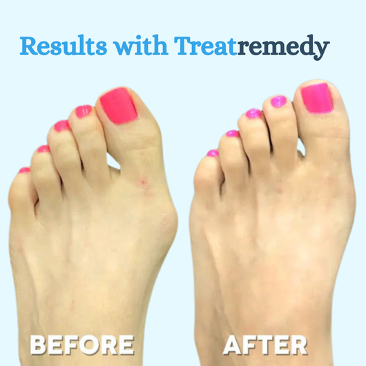 Treatremedy Bunion fix